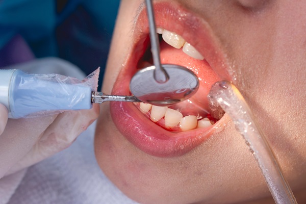 What Is A Deep Teeth Cleaning?