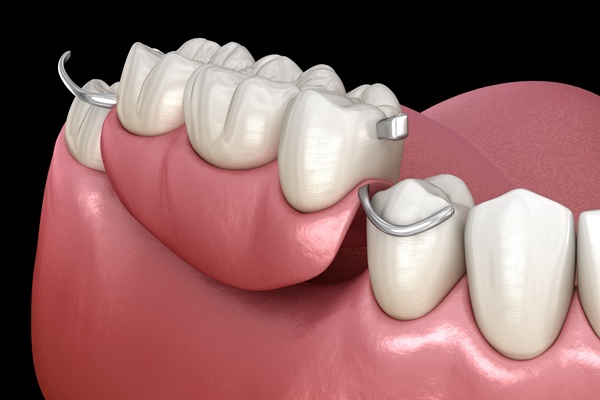 Tooth Replacement    : Why A Dentist May Recommend A Dental Bridge